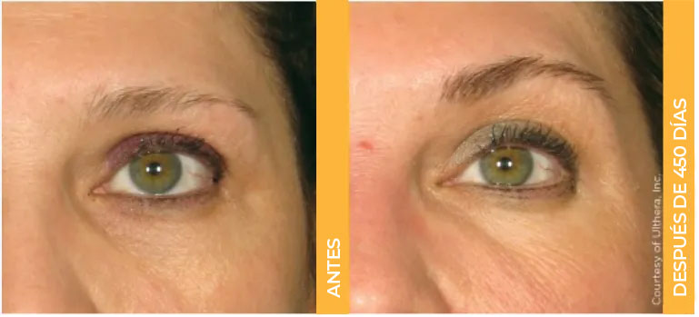 Primer plano de antes y después de las cejas de una paciente real de Ultherapy<sup>&reg;</sup>, que muestra resultados de lifting después de 450 días.