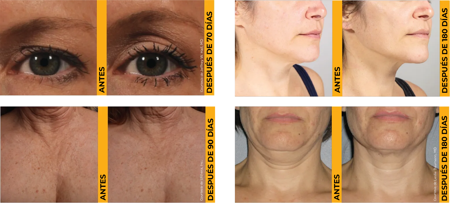 Cuatro fotos de antes y después que muestran resultados probados de lifting de piel en cejas, mentón, escote y cuello.