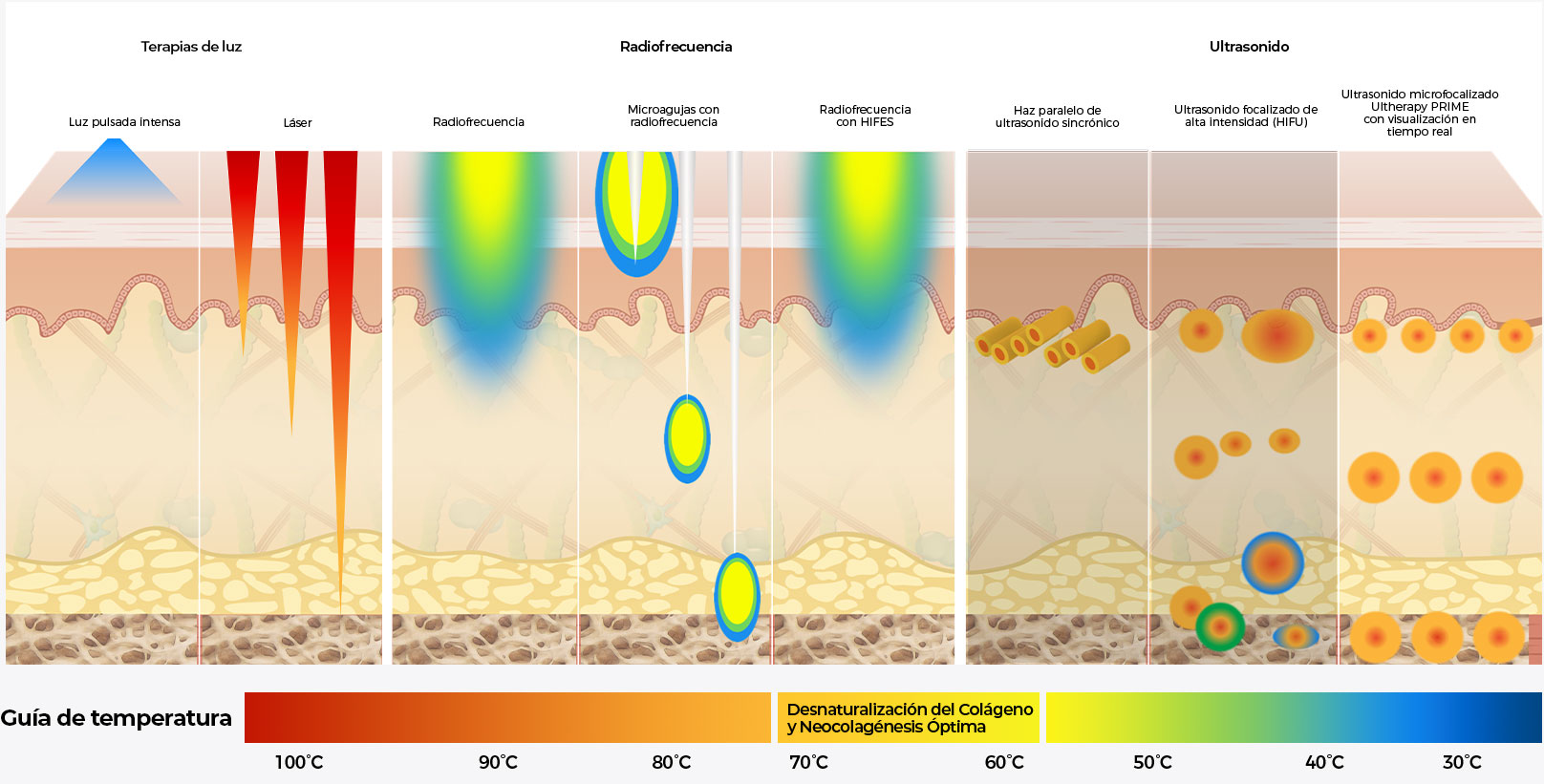 Diagrama que compara la profundidad de Ultherapy<sup>&reg;</sup> con la luz, la radiofrecuencia y otros tratamientos de ultrasonido en las capas de la piel.