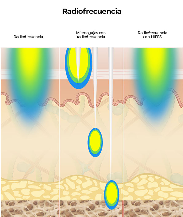 Diagrama que compara las terapias de radiofrecuencia con la mayor penetración de Ultherapy<sup>&reg;</sup> en las capas de la piel.