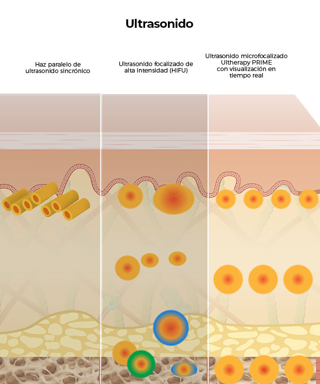 Diagrama que compara otros tratamientos de ultrasonido con la mayor penetración de Ultherapy<sup>&reg;</sup> en las capas de la piel.