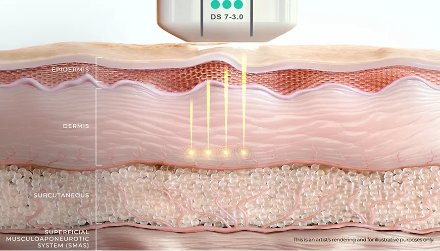 Diagrama de Ultherapy PRIME® que muestra el ultrasonido microfocalizado creando puntos de coagulación térmica a profundidades precisas de la piel.
