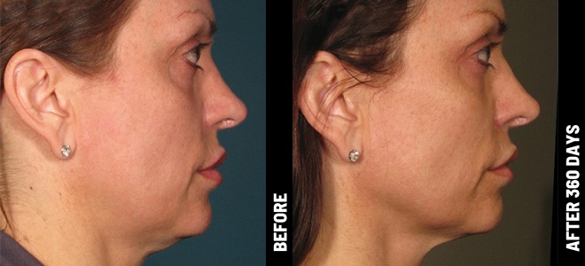 Imágenes de antes y después, una junto a la otra, que muestran resultados de lifting y tensado de piel tras Ultherapy. Diana, 62