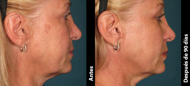 Imágenes de antes y después, una junto a la otra, que muestran resultados de lifting y tensado de piel tras Ultherapy. 