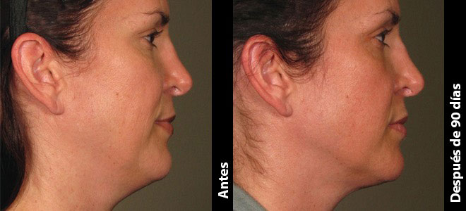Imágenes de antes y después, una junto a la otra, que muestran resultados de lifting y tensado de piel tras Ultherapy. 