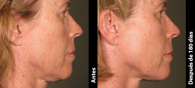 Imágenes de antes y después, una junto a la otra, que muestran resultados de lifting y tensado de piel tras Ultherapy. 