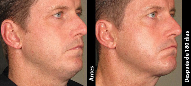 Imágenes de antes y después, una junto a la otra, que muestran resultados de lifting y tensado de piel tras Ultherapy. 
