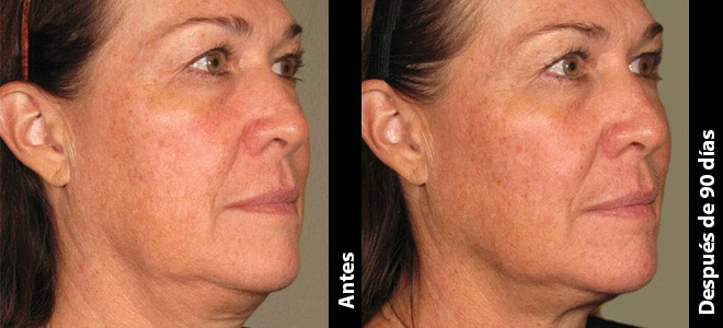 Imágenes de antes y después, una junto a la otra, que muestran resultados de lifting y tensado de piel tras Ultherapy. 