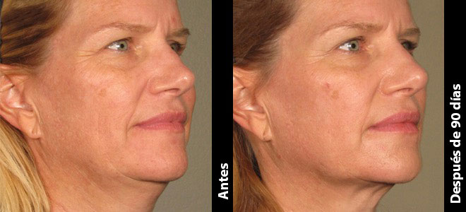 Imágenes de antes y después, una junto a la otra, que muestran resultados de lifting y tensado de piel tras Ultherapy. 
