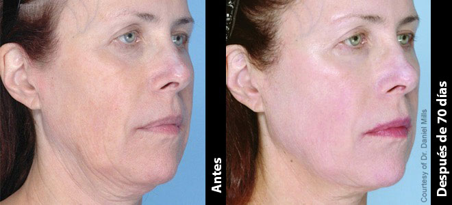 Imágenes de antes y después, una junto a la otra, que muestran resultados de lifting y tensado de piel tras Ultherapy. 