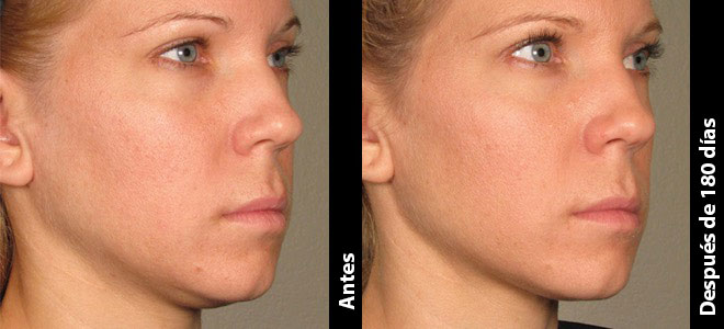 Imágenes de antes y después, una junto a la otra, que muestran resultados de lifting y tensado de piel tras Ultherapy. 