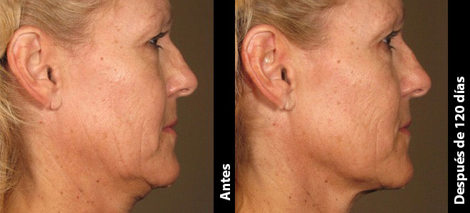 Imágenes de antes y después, una junto a la otra, que muestran resultados de lifting y tensado de piel tras Ultherapy. 