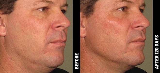 Imágenes de antes y después, una junto a la otra, que muestran resultados de lifting y tensado de piel tras Ultherapy. 